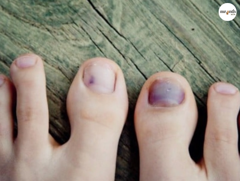 Những dấu hiệu đi giày dép chật