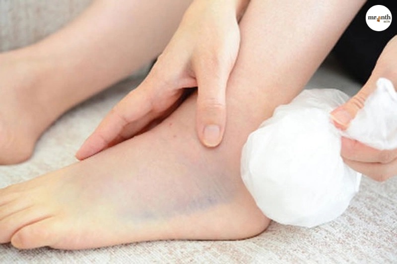 Chườm đá khi bị đau mẹo đi giày cao gót không đau mũi chân